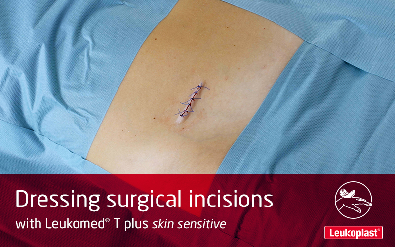Denne video viser, hvordan man beskytter kirurgiske snit på sårbar hud med Leukomed T plus skin sensitive: Vi ser en sundhedspersons hænder, der dækker et sår efter en operation på en patients mave.  Denne video viser, hvordan man beskytter kirurgiske snit på sårbar hud med Leukomed T plus skin sensitive: Vi ser en sundhedspersons hænder, der dækker et sår efter en operation på en patients mave.